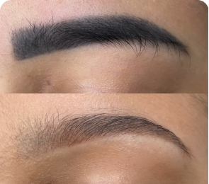 Despigmentação Despigmentação